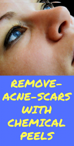 remove-acne-scars With Chemica peels