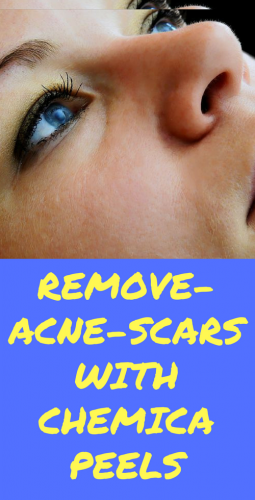 remove-acne-scars With Chemica peels