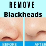 Remove Blackheads From The Nose