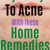 Home Remedies For Acne Treatment