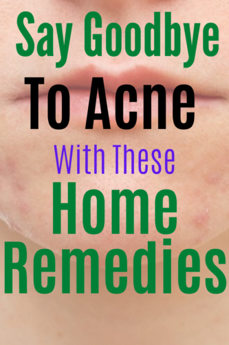 Home Remedies For Acne Treatment