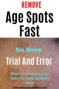 Remove Age Spots At Home With Ease