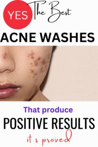 Facial acne